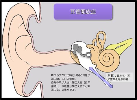 耳咽管 開放 症
